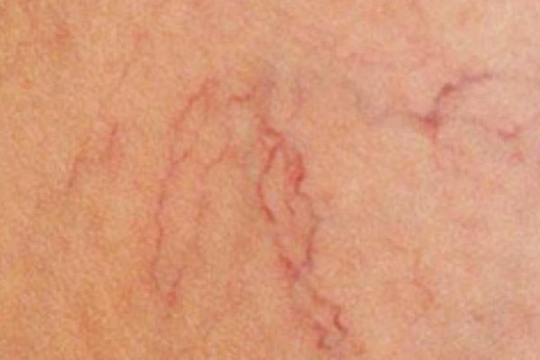 Действенное лекарство от варикоза есть в каждой аптеке! Но мало кто догадывается об этом…