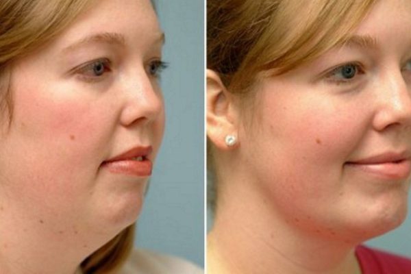 Тренировка для лица: как убрать второй подбородок с помощью простых упражнений.