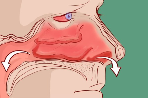 Вот как мне удалось избавиться от заложенности носа: методика, проверенная тысячами людей!