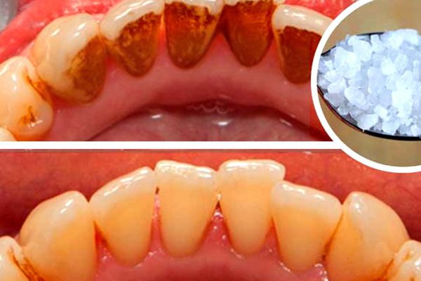 Это средство отбелит даже самые желтые зубы и удалит гадкий зубной камень! Потрясающий эффект…