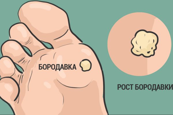 Растения, которые избавят тебя от бородавок раз и навсегда!