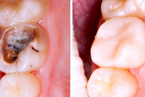 Остановить кариес возможно! Эти 5 шагов помогут вернуть зубам прежний вид…