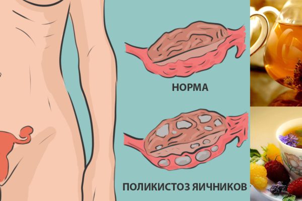 Натуральное средство для лечения поликистоза яичников: никаких гормонов.