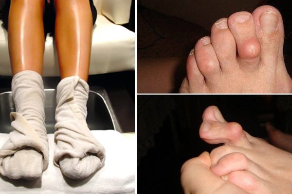 Первоклассное средство при ревматоидном артрите: боль прошла, а косточки стали меньше!