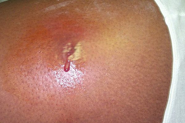 Золотистый стафилококк: лечение народными средствами