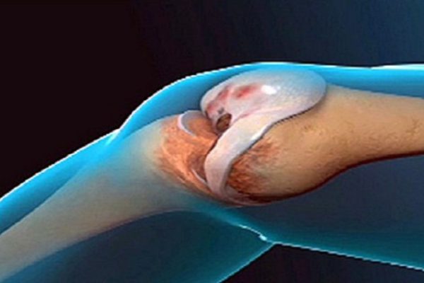 Врачи шокированы: это средство улучшает структуру костной ткани и восстанавливает суставы!