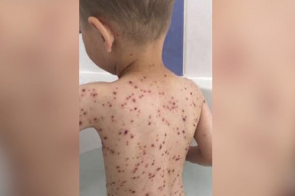 То, чего ни в коем случае нельзя делать при ветрянке! Мы рискуем здоровьем детей.