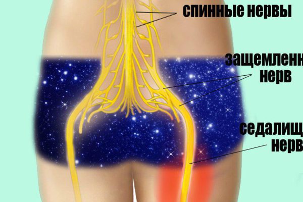 Успех в 95 % случаев! Защемление или растягивание седалищного нерва убирается, если…