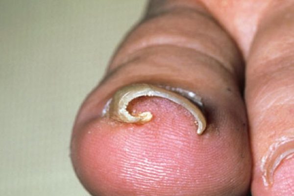 Дедушкин совет лечения вросшего ногтя. Избавься от этой проблемы раз и навсегда!