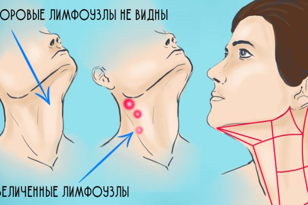 Лимфа — живая вода для организма! «Если бывают ангины, если бы фарингит, синусит и прочие…»
