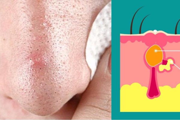 Как сузить поры на лице? 10 действенных советов помогут избавиться от проблемы!