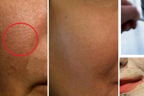 Всего один ингредиент убрал расширенные поры на лице! Нужно срочно попробовать…