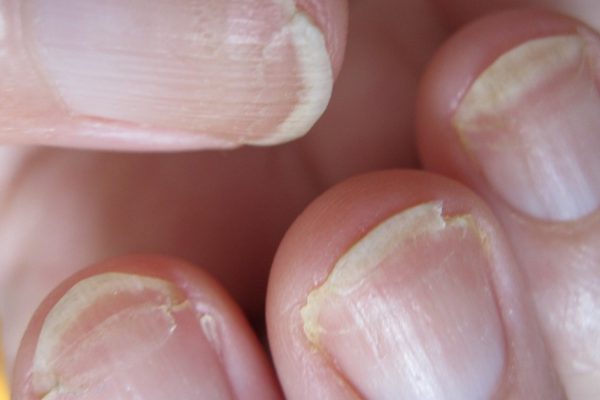 Женщина увидела странные полосы на ногтях. Кто бы мог подумать, что ЭТО спасет ей жизнь!