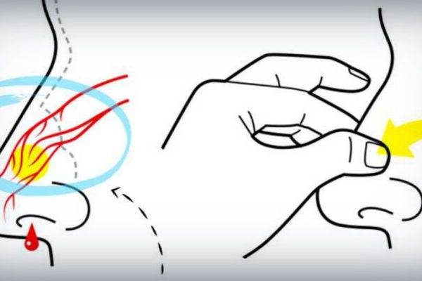 6 приемов, которые помогут быстро остановить кровотечение из носа.