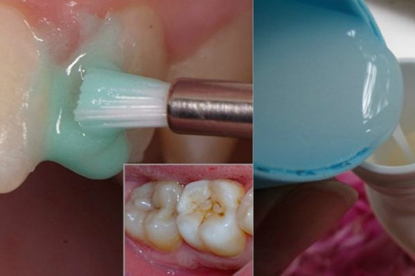 Эффективное отбеливание зубов в домашних условиях: лучше профессиональной чистки!