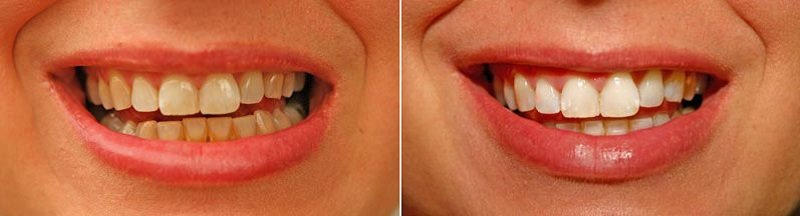 Отбеливание зубов на 6 тонов фото до и после