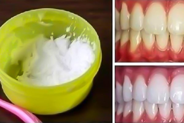Как отбелить зубы в домашних условиях за 3 минуты: 100%-й результат!