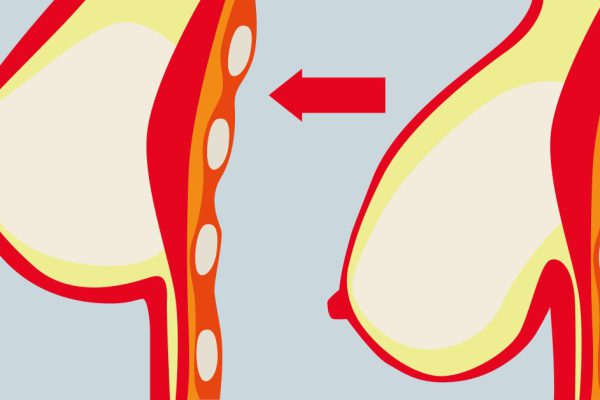 Эти 3 приема вернут груди утраченную форму: в комплексе еще эффективнее!