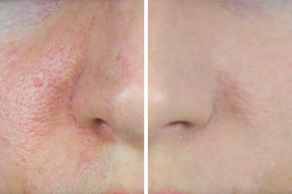 Как уменьшить расширенные поры! Маленькая хитрость для мраморной кожи.