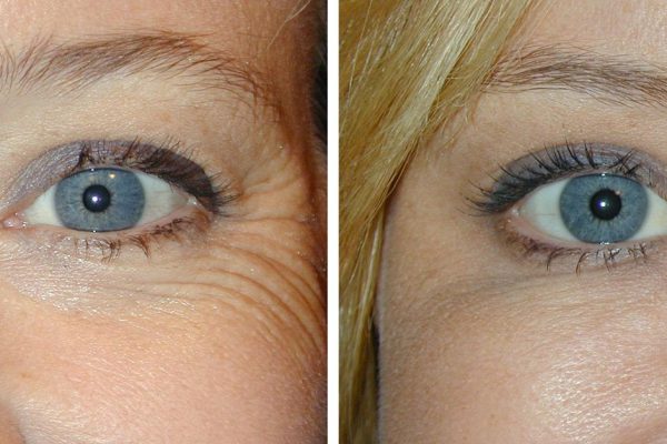 Ни за что не поверишь, что помогло мне омолодить кожу… Достаточно всего одной процедуры!