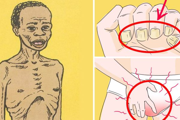 Эти сигналы нельзя игнорировать! Лишь 1 % населения узнает о проблемах с печенью вовремя.