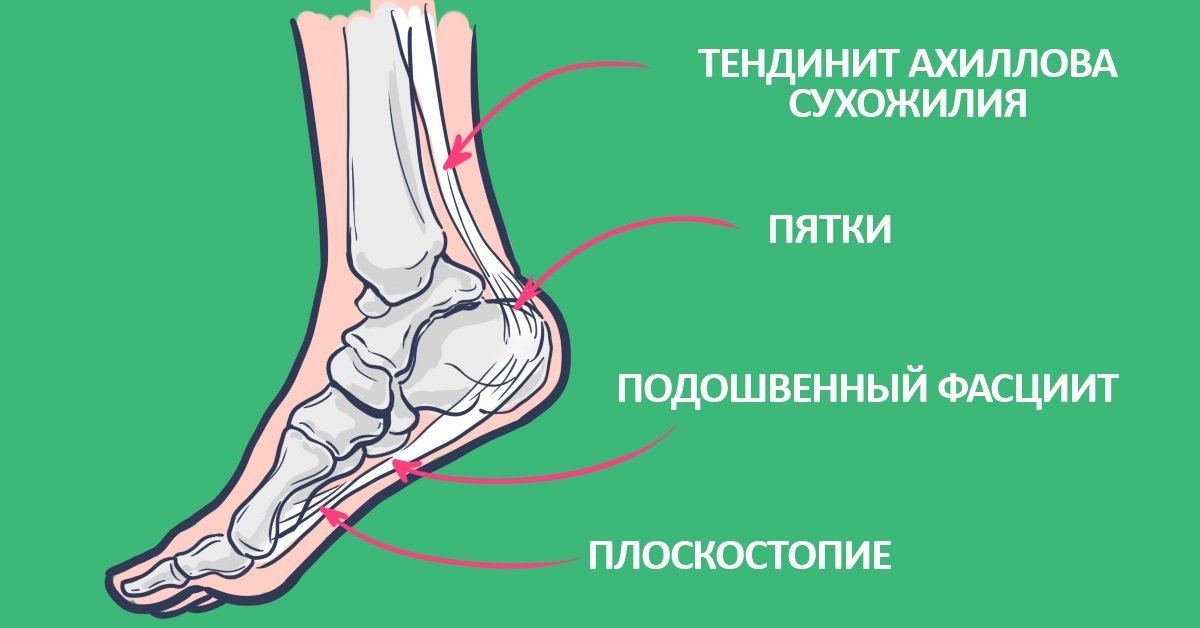 Ноги гудят и ноют. Плоскостопие ахиллова сухожилия. Пяточная ахиллова сухожилия.