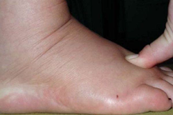 Попрощайся с задержкой жидкости, отеками и лишним весом всего за 1 неделю с этим удивительным…