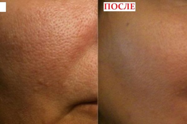 Как уменьшить расширенные поры: 8 эффективных рецептов!