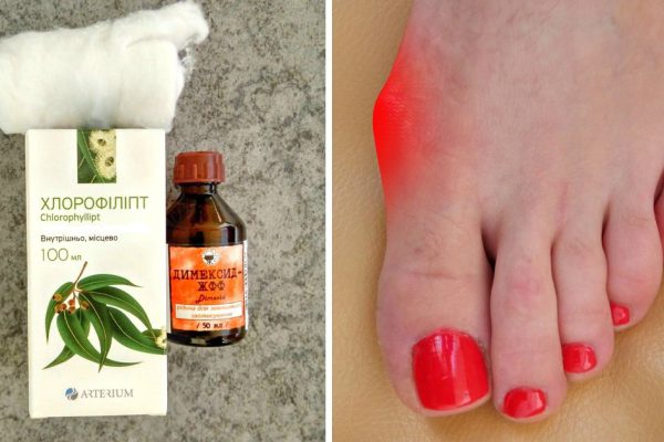 Косточка больше не болит! Потратила мелкие деньги на 2 средства, эффект невероятен.