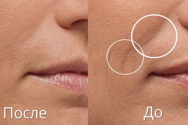 Как самостоятельно избавиться от носогубных складок. Способы на вес золота!