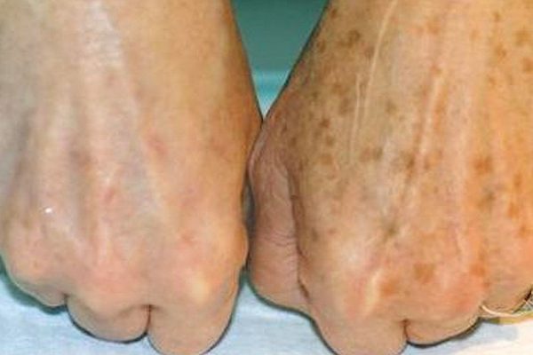 Увидев коричневые пятнышки на руках, она ужаснулась! Хорошо, что под рукой было это…