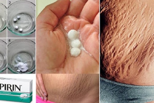 Куда делись растяжки? Копеечное средство из аптеки сделало кожу божественной!