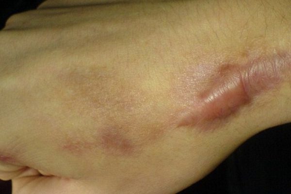 Как убрать шрамы при помощи натуральных средств. Для моей кожи это спасение!