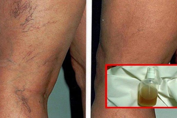 Бальзам из натуральных компонентов: лучший способ убрать сосудистую сетку и вернуть коже красоту!