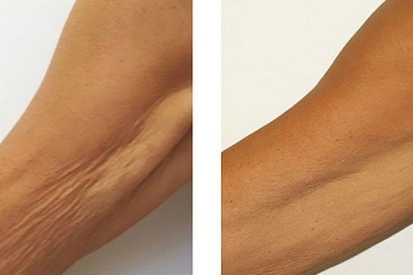 Рыхлые бедра, шея с морщинками, дряблые руки? Ситуация изменится, стоит лишь начать делать так.