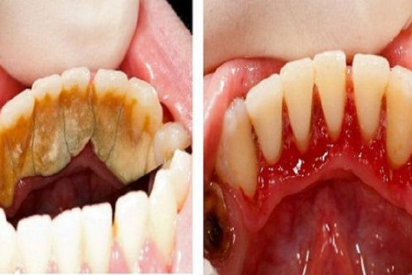 Узнай, как легко удалить зубной камень и сделать улыбку белоснежной! Даже не надеялась на такой эффект…