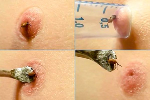 Чтобы вытащить клеща из ноги, он использовал лишь один предмет! Посмотрел это видео и научился.