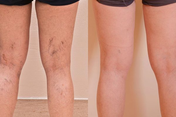 Наконец-то удалось избавиться от сосудистых звездочек. Здоровый вид — вот ключ к красоте!