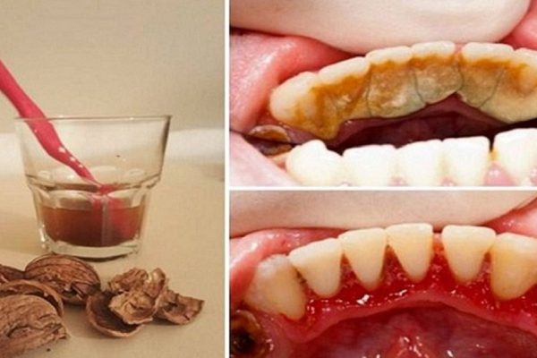 Как избавиться от зубного камня при помощи 1 простого средства.