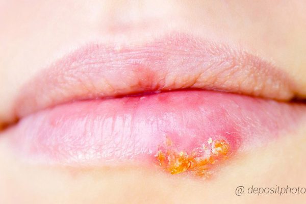 Если у тебя часто бывает герпес, попробуй этот метод. Иммунитет воскреснет!