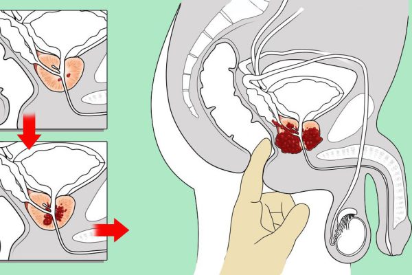 Лечение рака простаты, рака яичников и рака прямой кишки: однокомпонентное средство!