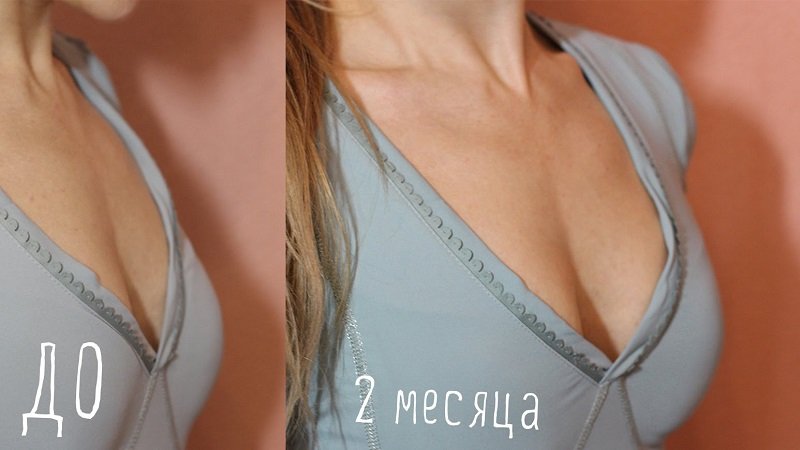 гърдите преди и след