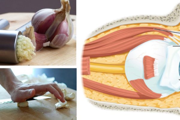 Как восстановить зрение с помощью чеснока. Никаких операций!