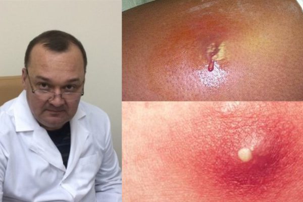 Мгновенная помощь от нарывов и фурункулов. Эта проблема не только наружная!