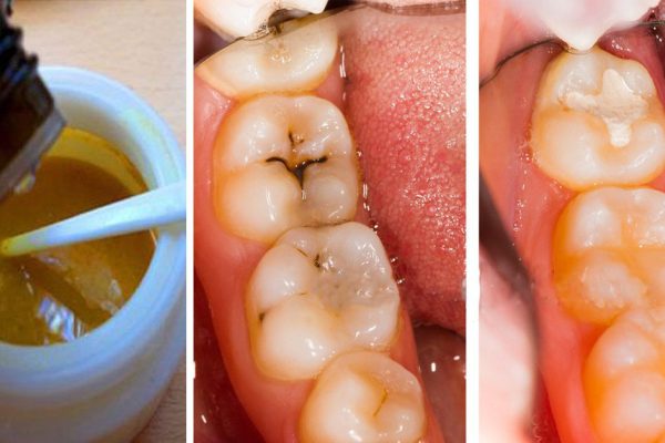 Эта маска для зубов оставит стоматологов без работы! Всего 4 компонента…