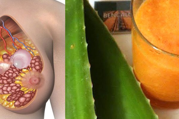 Домашнее средство всего из двух ингредиентов поможет избавиться от кисты молочной железы.