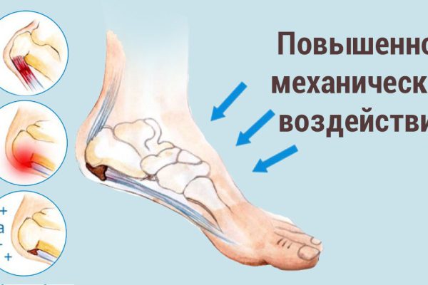 Пяточная шпора: самое эффективное средство для снятия воспаления и боли!