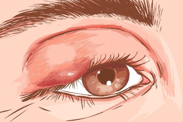 Close up of an eye with an infected eyelid