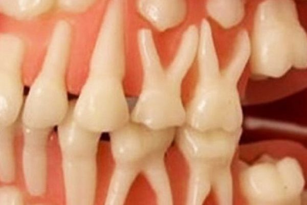 Вырастить новые зубы за 9 недель: процедура, которая возможна в любом возрасте!