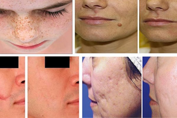 Следы от угрей, рубцы и пигментные пятна: натуральное домашнее средство сотрет с лица всё!